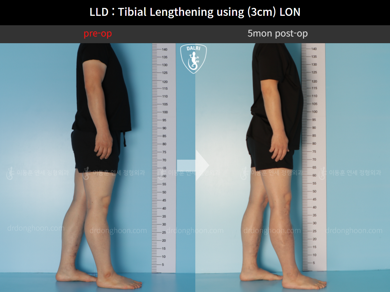 Before and after adult lld, case 11139768, image 3, Dr. Donghoon institute (DALRI)