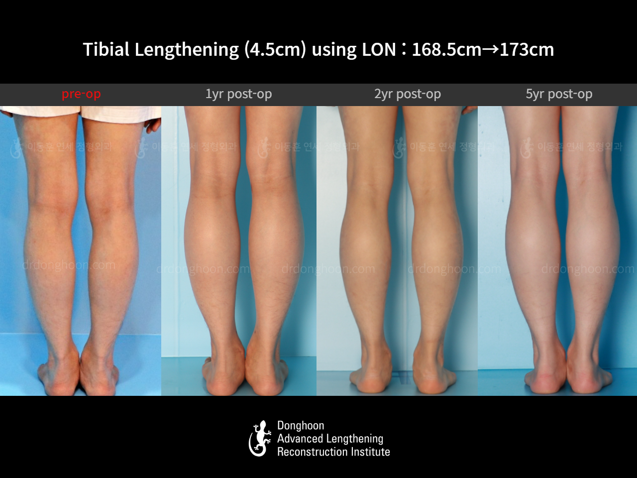 Before and after cll lon, case 16140967, image 11, Dr. Donghoon institute (DALRI)