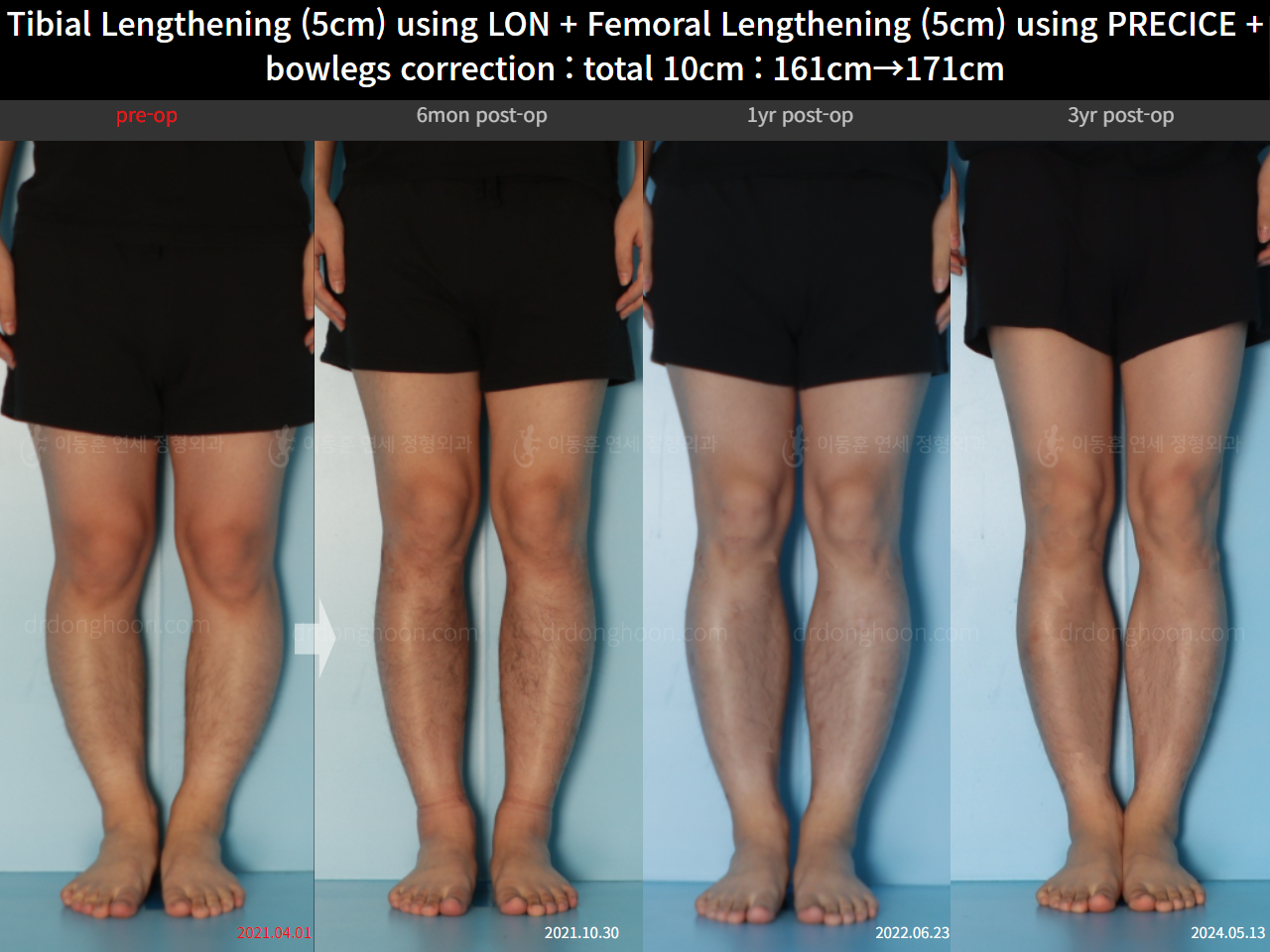 Before and after cll + deformity correction, case 22208435, image 7, Dr. Donghoon institute (DALRI)