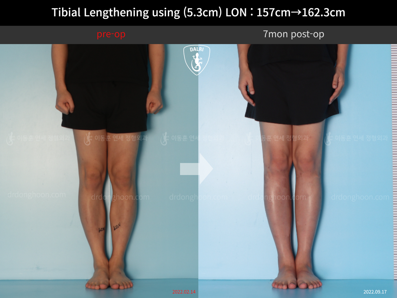 Before and after cll lon, case 12844512, image 6, Dr. Donghoon institute (DALRI)