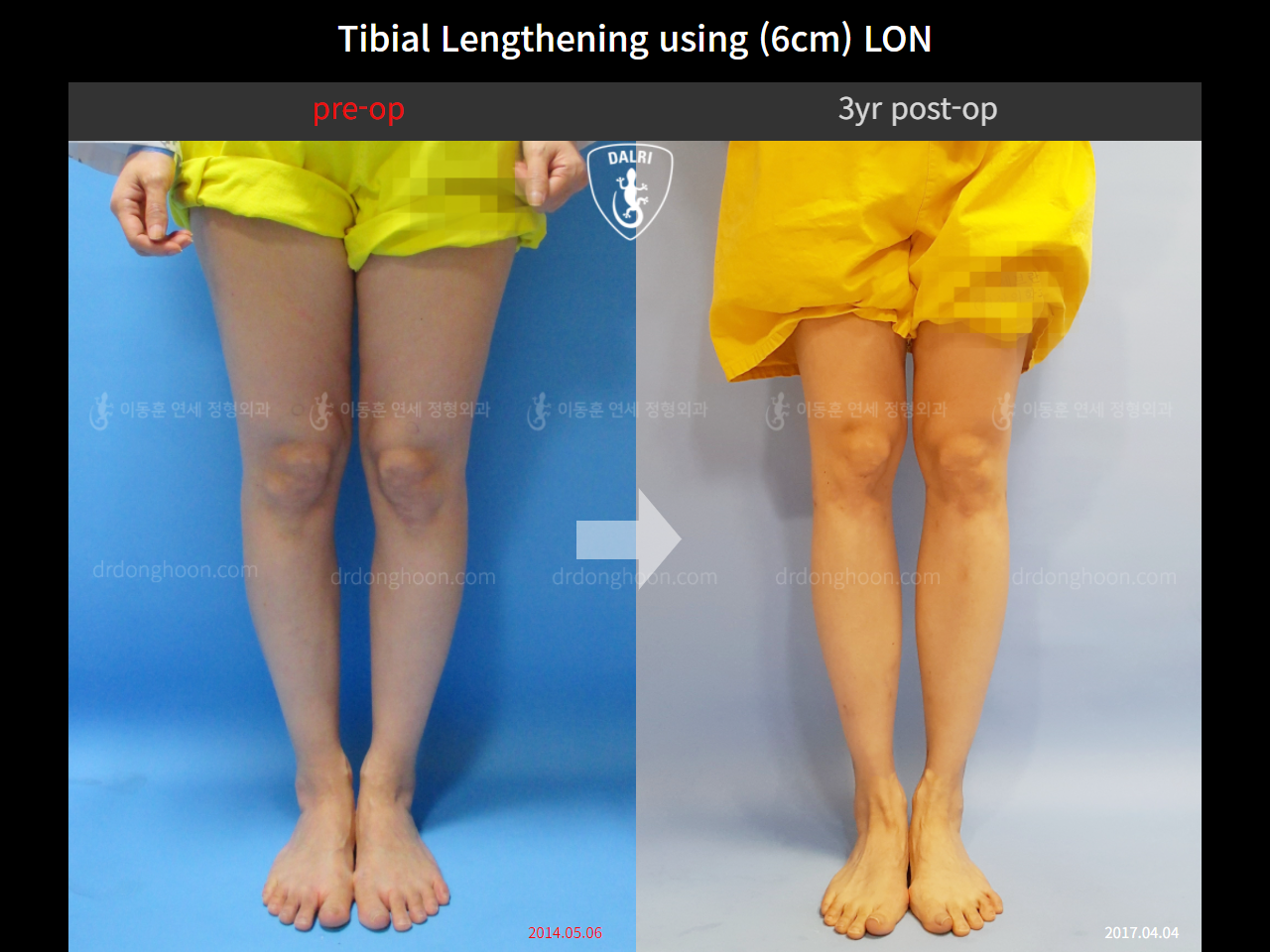 Before and after cll lon, case 4323981, image 5, Dr. Donghoon institute (DALRI)