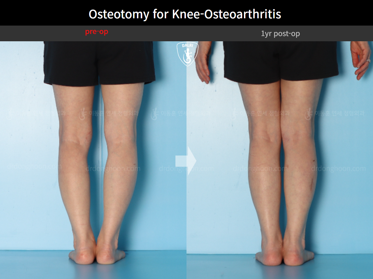 Before and after osteotomy for knee osteoarthritis, case 16893966, image 7, Dr. Donghoon institute (DALRI)