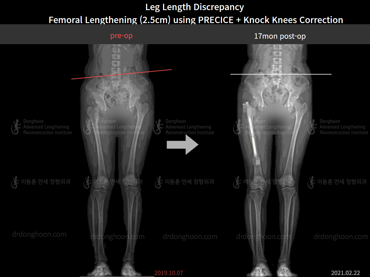 Before and after adult lld, case 8385191, image 6, Dr. Donghoon institute (DALRI)