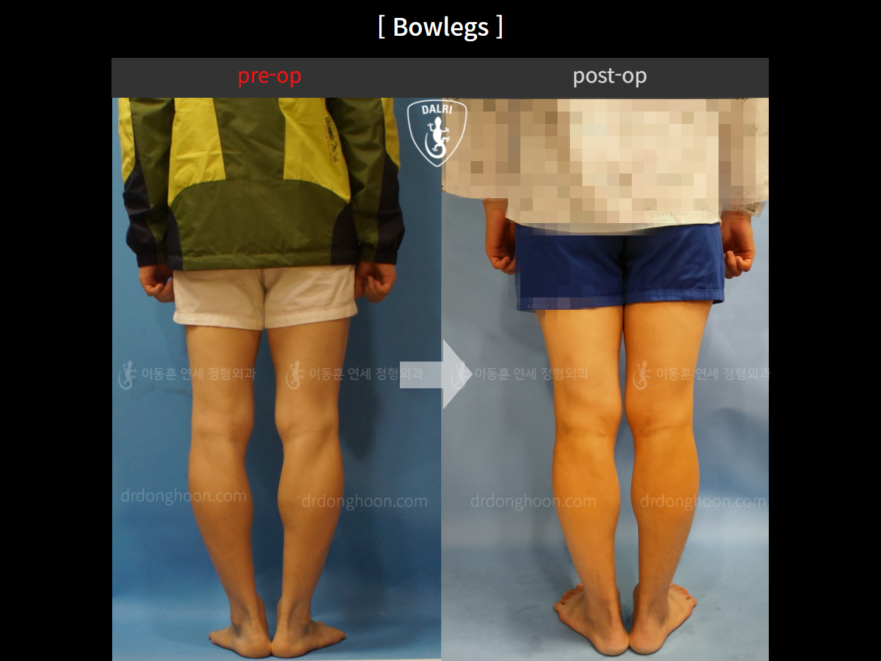 Before and after adult bowlegs, case 4311160, image 4, Dr. Donghoon institute (DALRI)