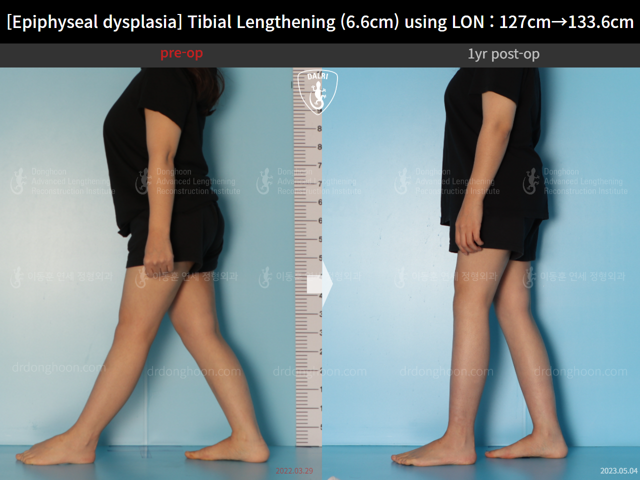 Before and after congenital condition, case 15072062, image 6, Dr. Donghoon institute (DALRI)