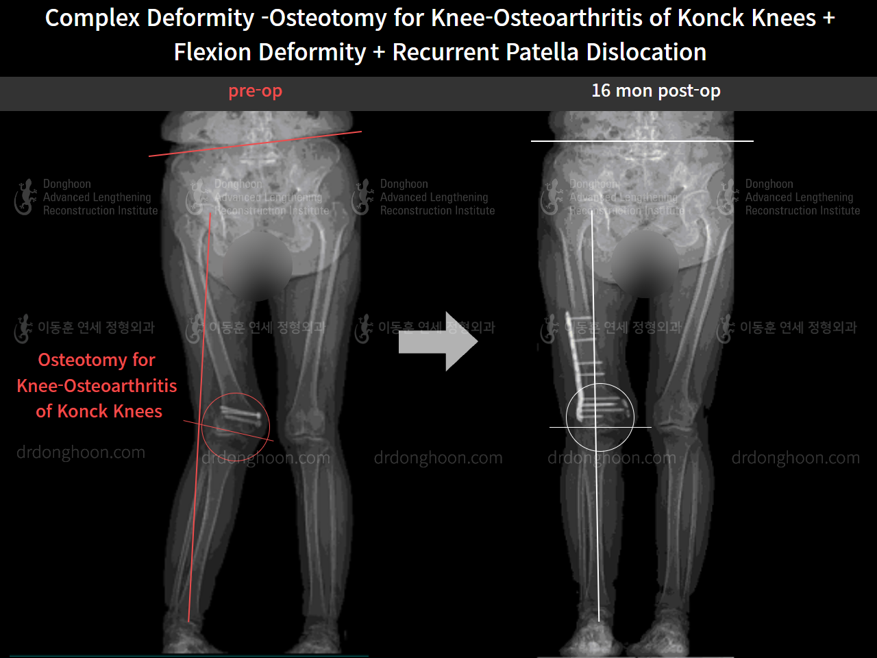 Before and after recurrent patella dislocation, case 8580605, image 3, Dr. Donghoon institute (DALRI)