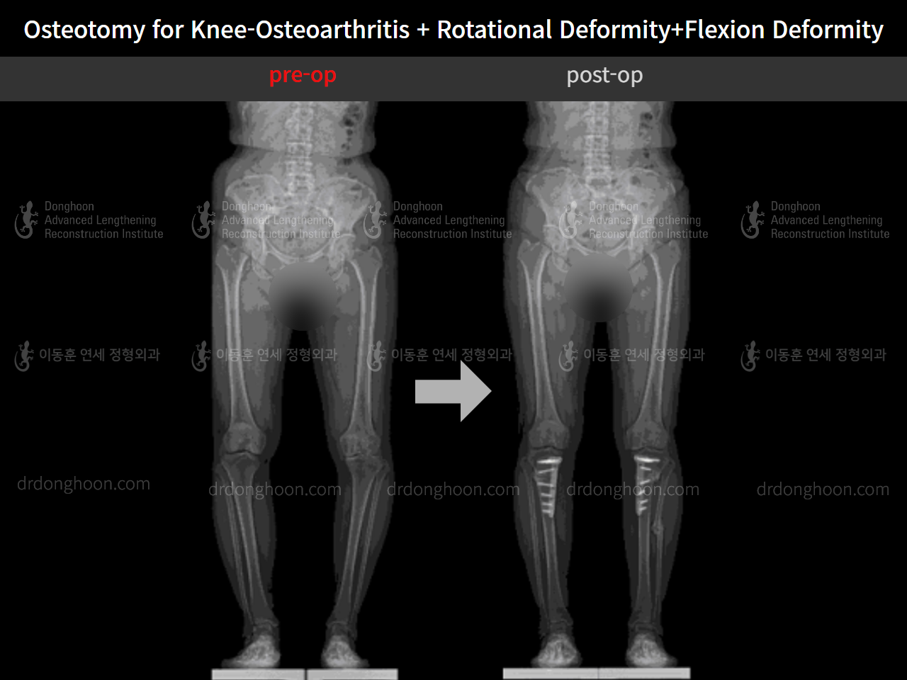 Before and after osteotomy for knee osteoarthritis, case 5987662, image 8, Dr. Donghoon institute (DALRI)