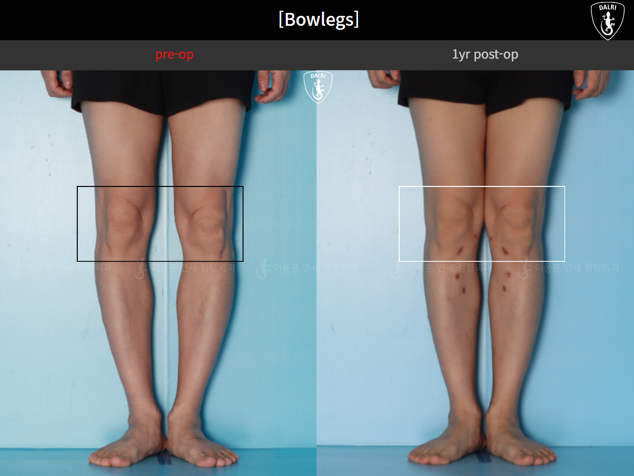 Before and after adult bowlegs, case 125438866, image 9, Dr. Donghoon institute (DALRI)