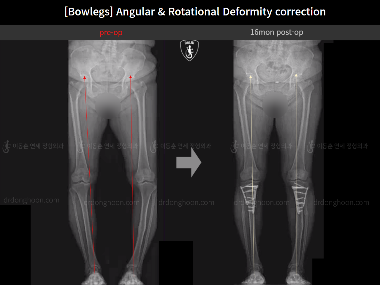 Before and after adult bowlegs, case 14637299, image 7, Dr. Donghoon institute (DALRI)