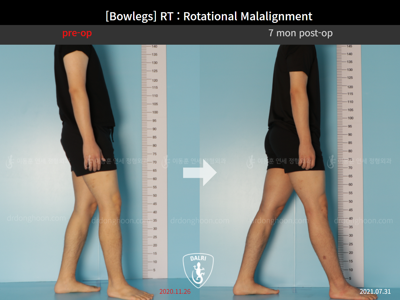Before and after adult bowlegs, case 9190873, image 5, Dr. Donghoon institute (DALRI)