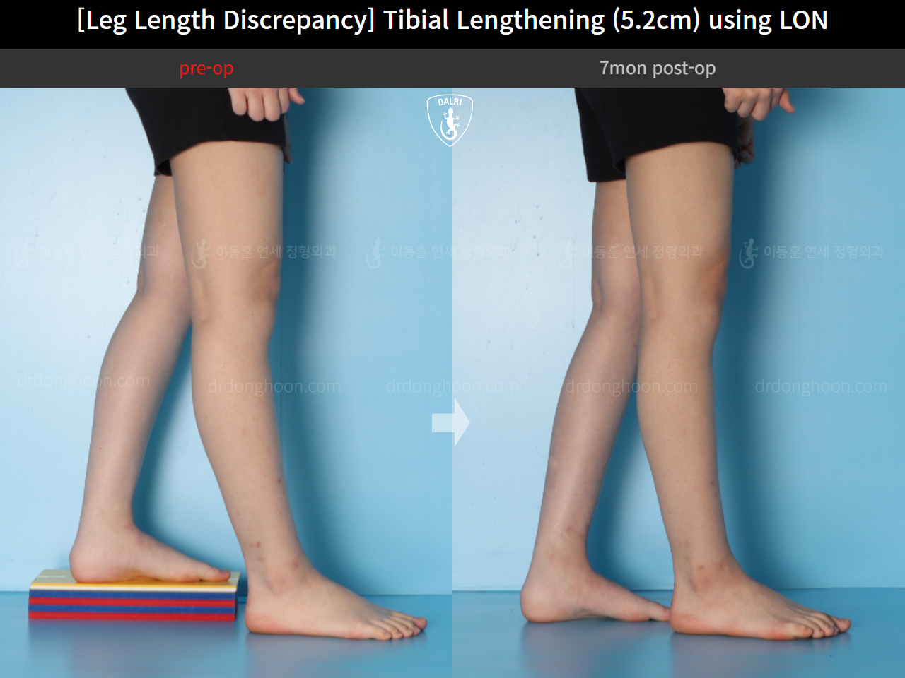 Before and after adult lld, case 16539955, image 6, Dr. Donghoon institute (DALRI)