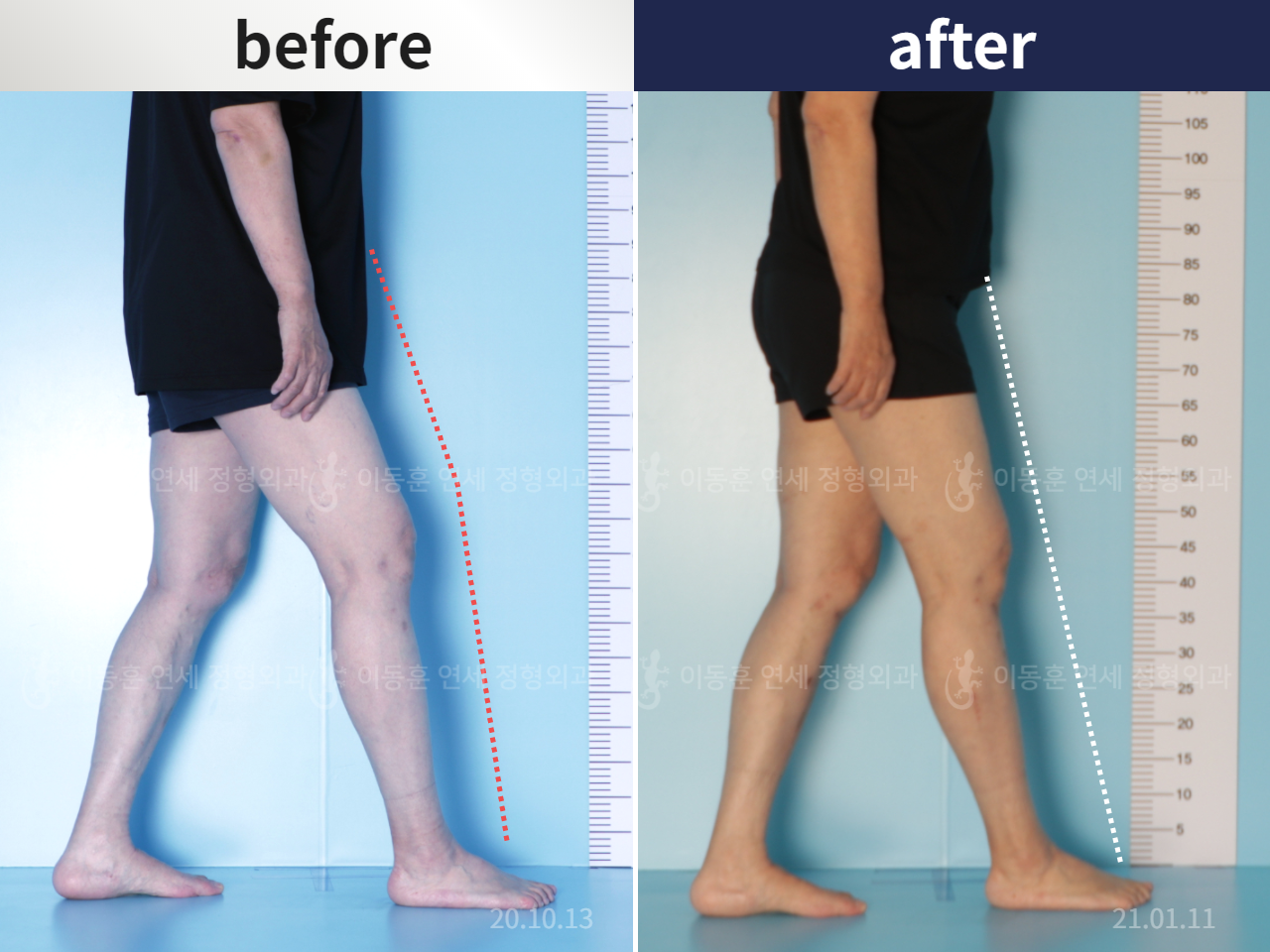 Before and after flexion deformity, case 6007892, image 1, Dr. Donghoon institute (DALRI)