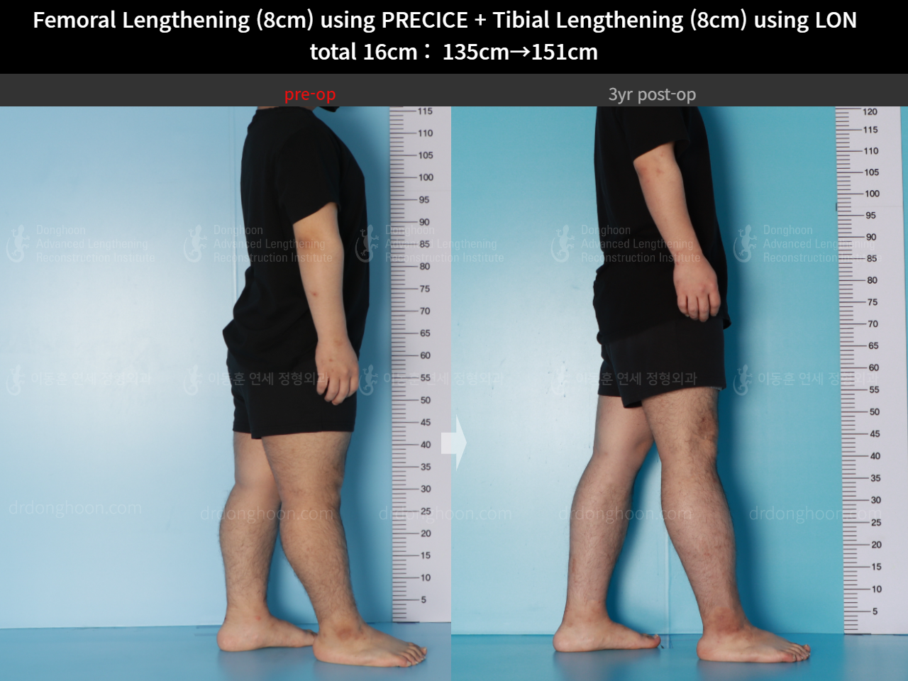 Before and after cll lon, case 16524730, image 7, Dr. Donghoon institute (DALRI)