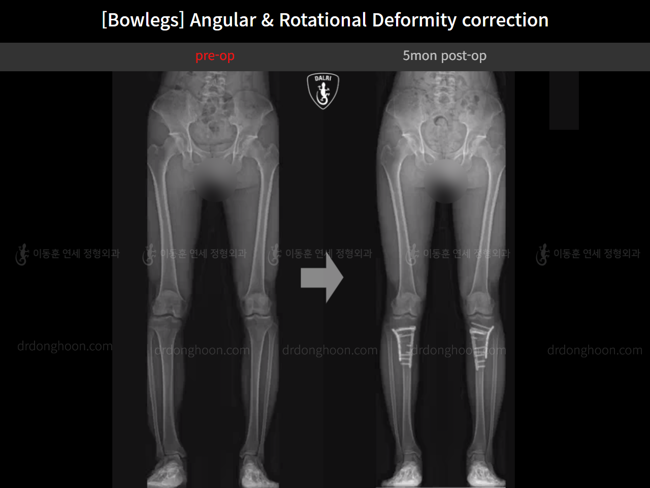 Before and after adult bowlegs, case 14707617, image 11, Dr. Donghoon institute (DALRI)