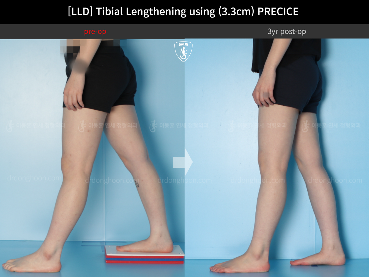 Before and after adult lld, case 14064905, image 10, Dr. Donghoon institute (DALRI)