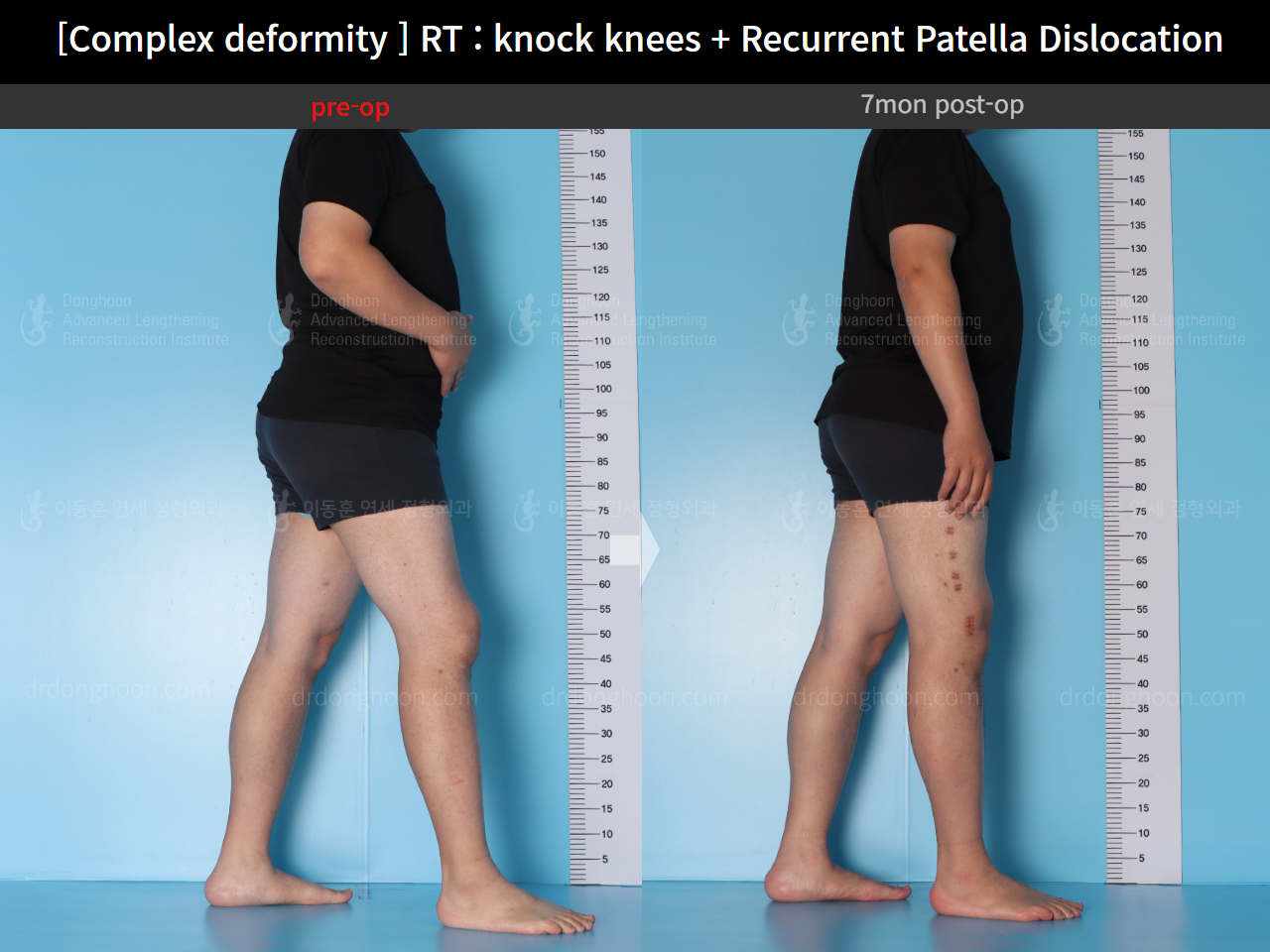 Before and after recurrent patella dislocation, case 16147031, image 5, Dr. Donghoon institute (DALRI)