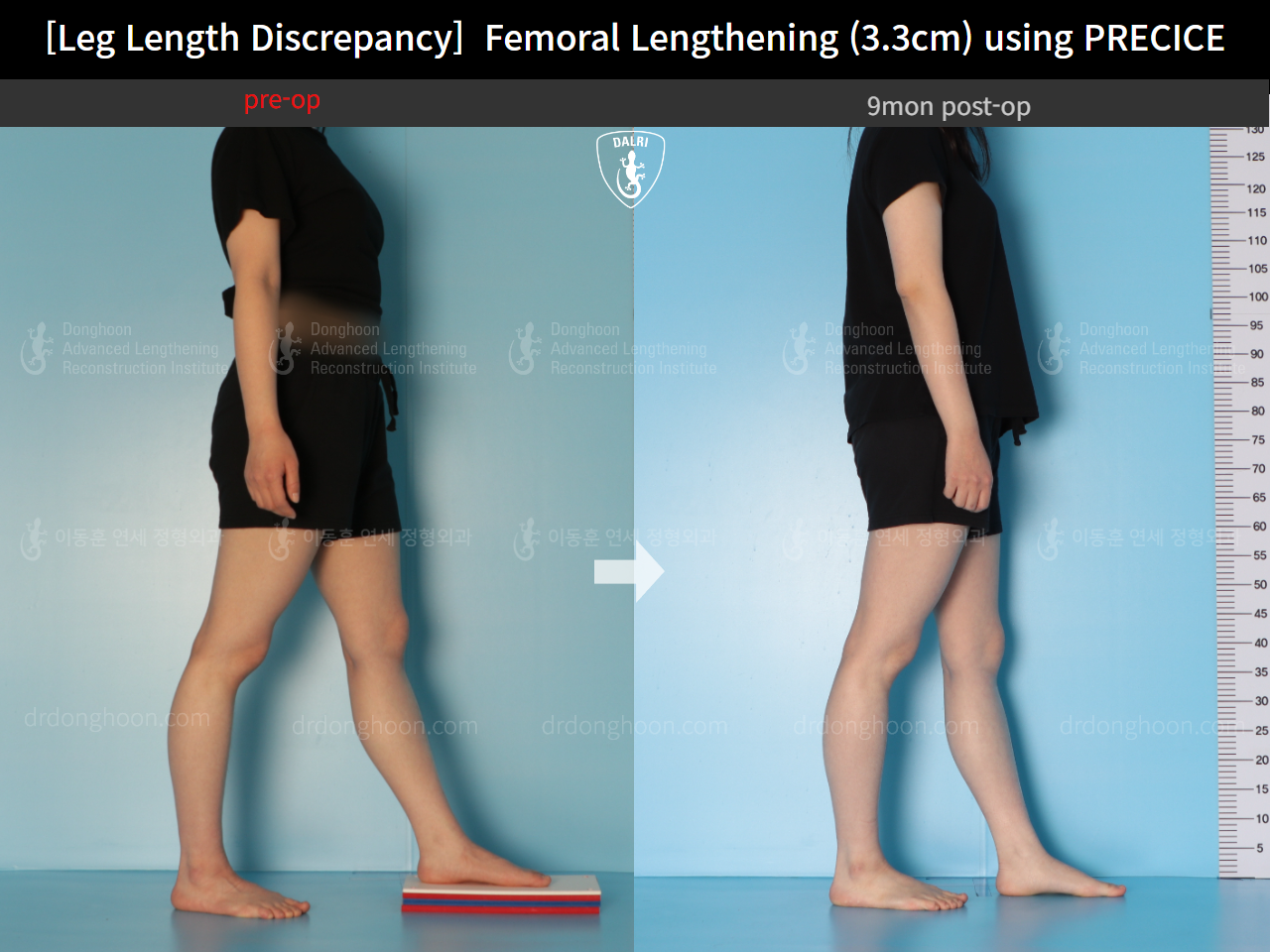 Before and after adult lld, case 14602297, image 4, Dr. Donghoon institute (DALRI)