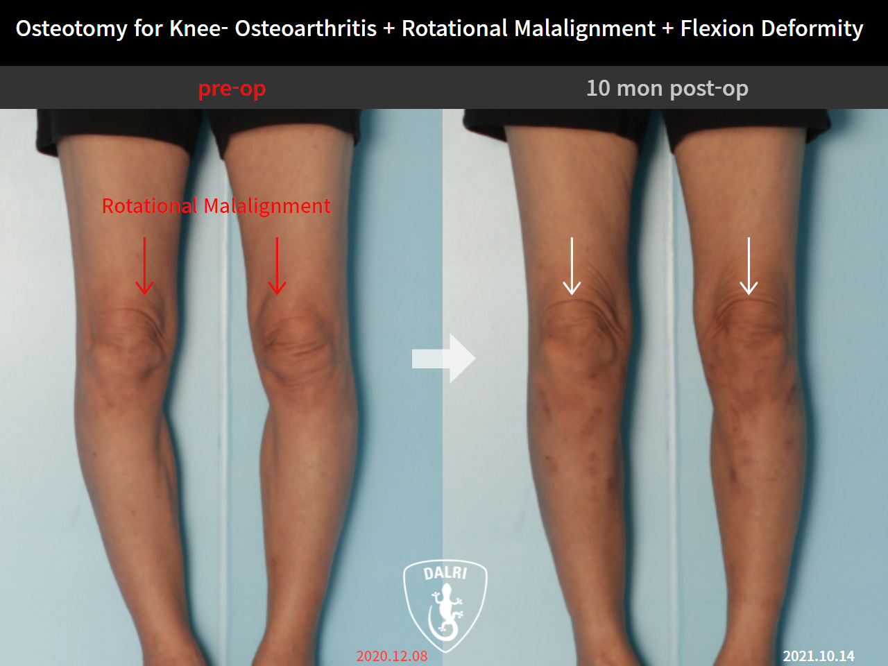 Before and after osteotomy for knee osteoarthritis, case 9128503, image 3, Dr. Donghoon institute (DALRI)