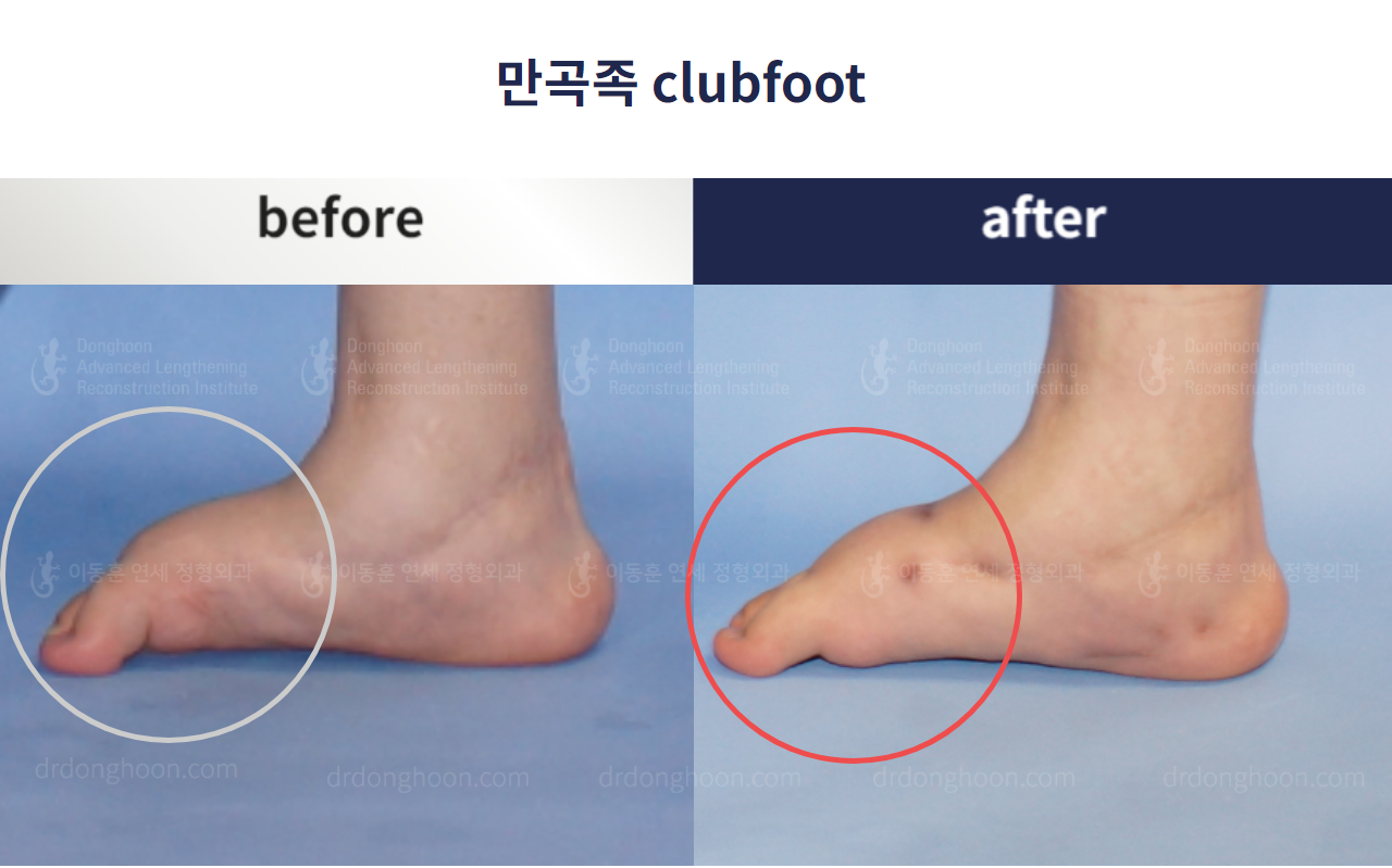 Before and after congenital clubfoot, case 4233833, image 2, Dr. Donghoon institute (DALRI)
