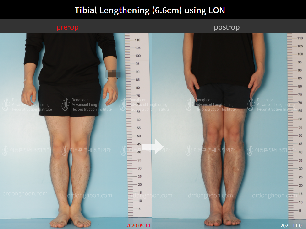 Before and after cll lon, case 8764128, image 5, Dr. Donghoon institute (DALRI)