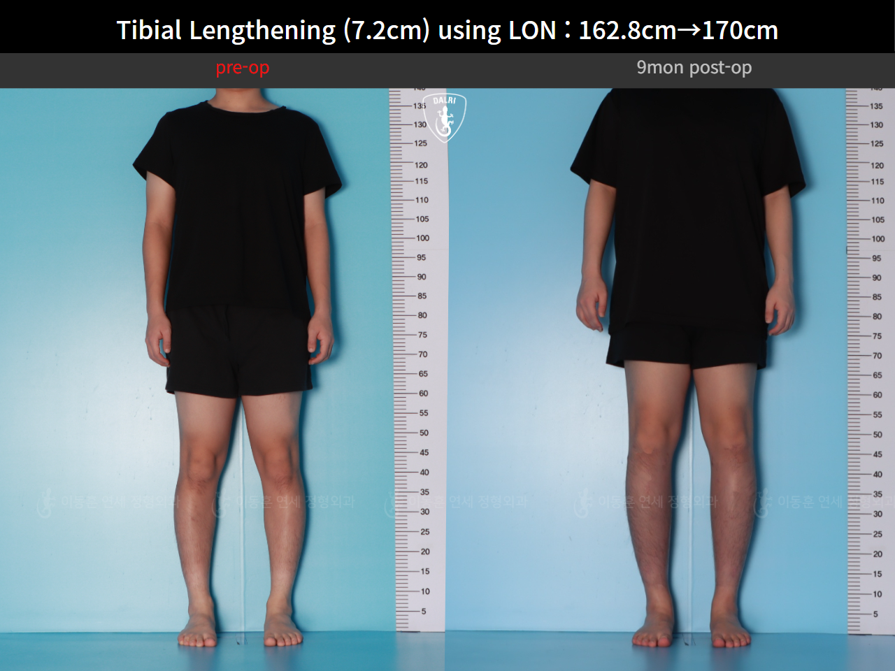 Before and after cll lon, case 124820559, image 2, Dr. Donghoon institute (DALRI)
