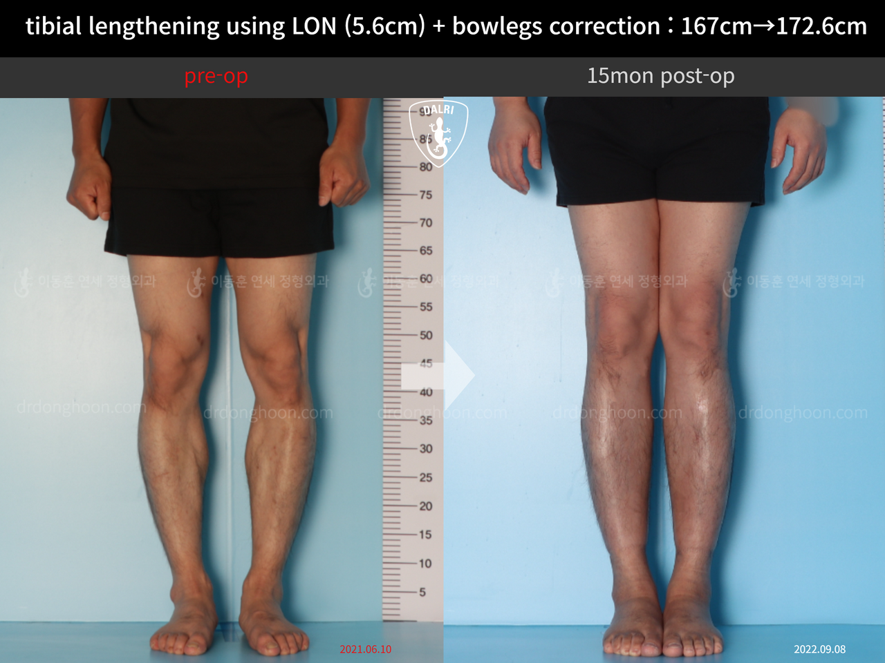 Before and after cll + deformity correction, case 12804946, image 5, Dr. Donghoon institute (DALRI)