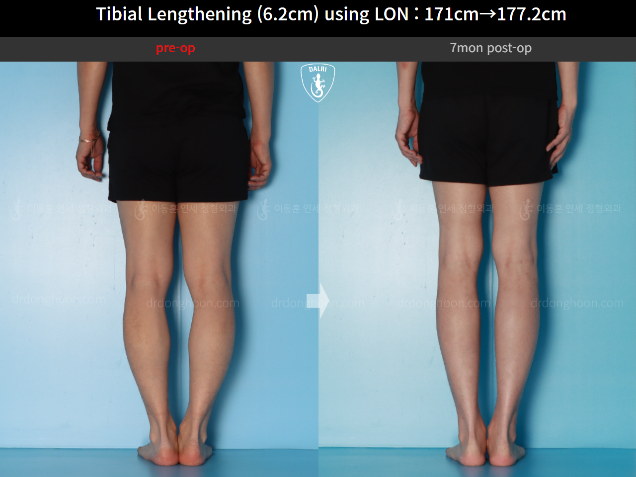 Before and after cll lon, case 16713373, image 9, Dr. Donghoon institute (DALRI)