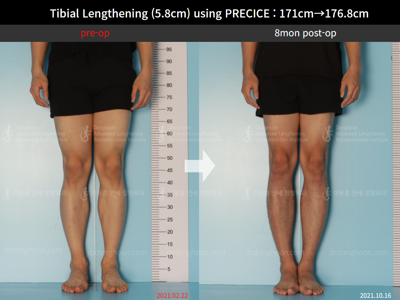 Before and after cll precice, case 8678696, image 5, Dr. Donghoon institute (DALRI)