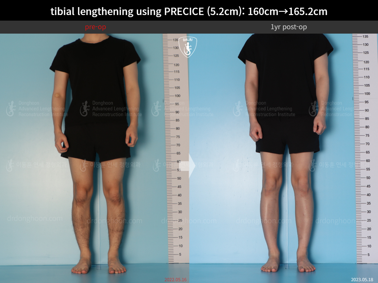 Before and after cll precice, case 15213098, image 2, Dr. Donghoon institute (DALRI)