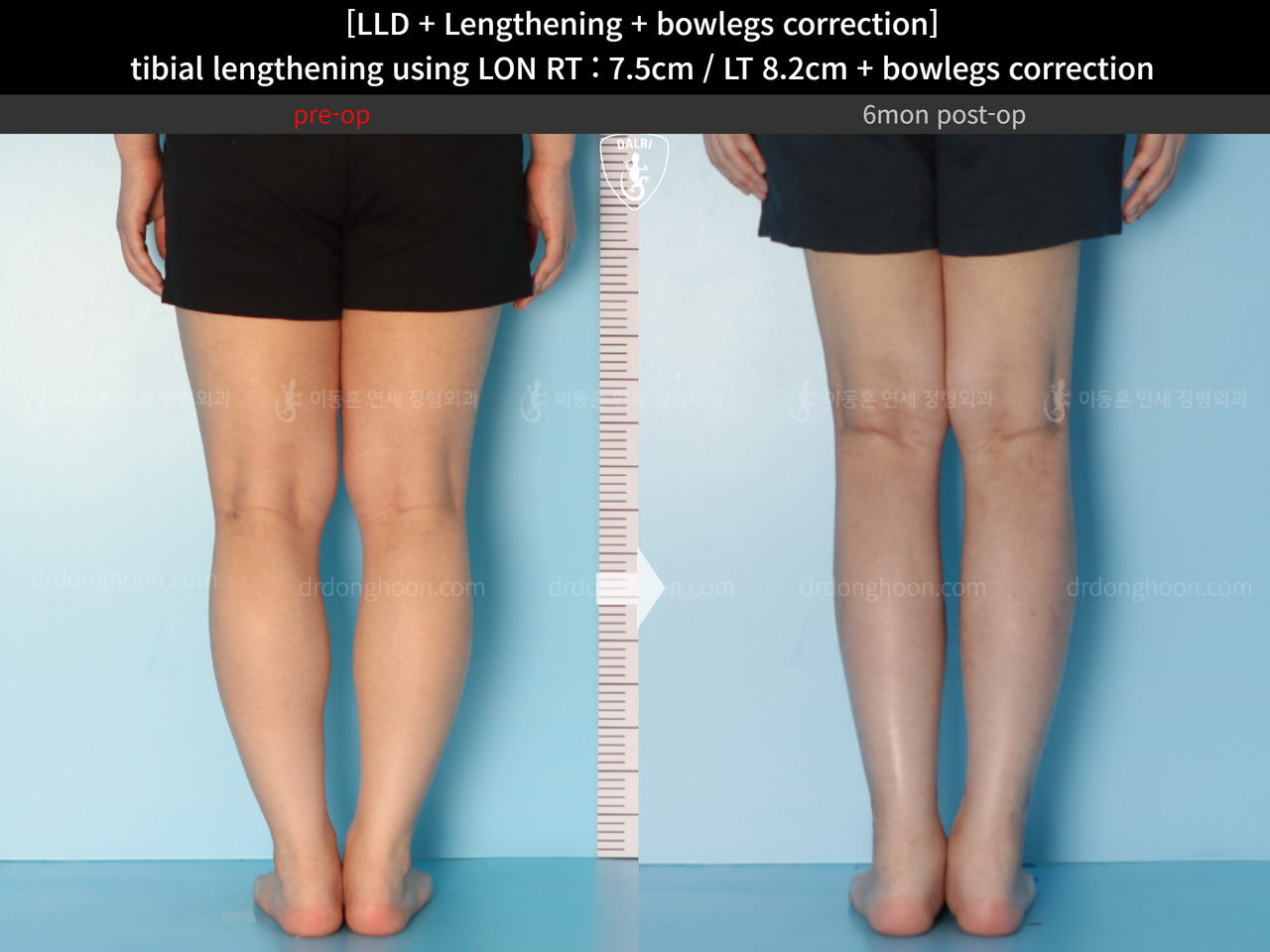 Before and after cll + deformity correction, case 14399778, image 4, Dr. Donghoon institute (DALRI)