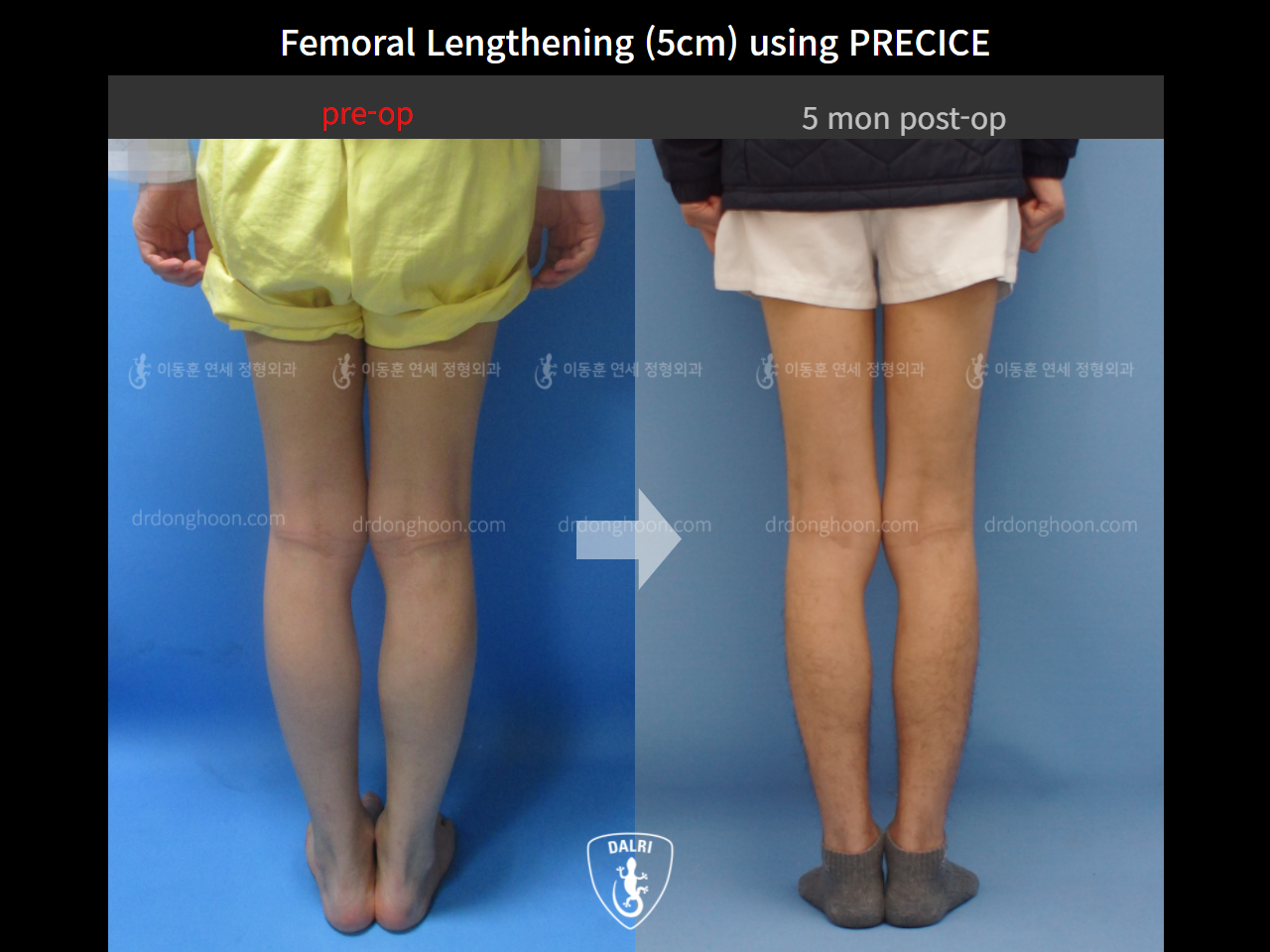 Before and after cll precice, case 9231745, image 5, Dr. Donghoon institute (DALRI)