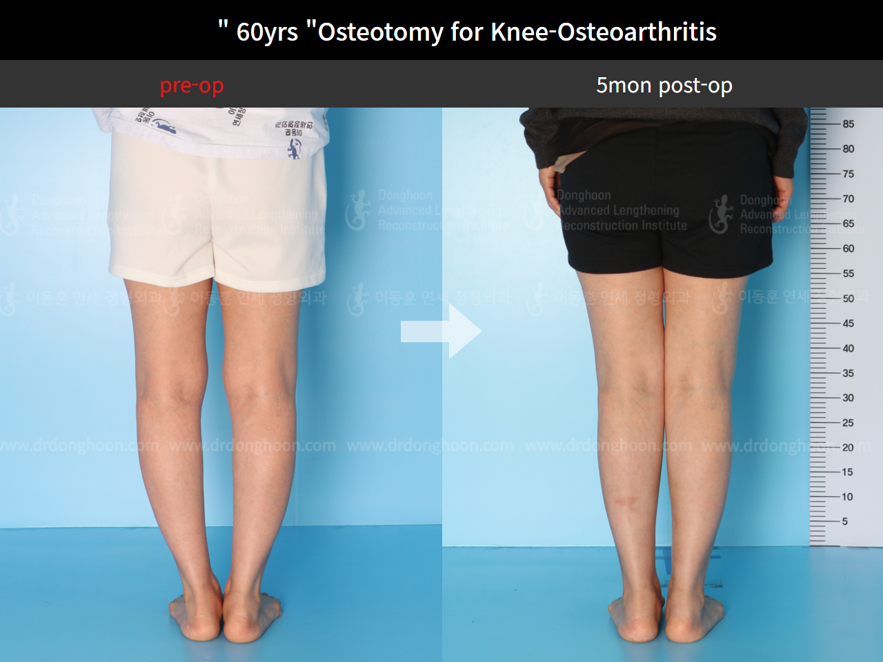 Before and after osteotomy for knee osteoarthritis, case 4586357, image 5, Dr. Donghoon institute (DALRI)