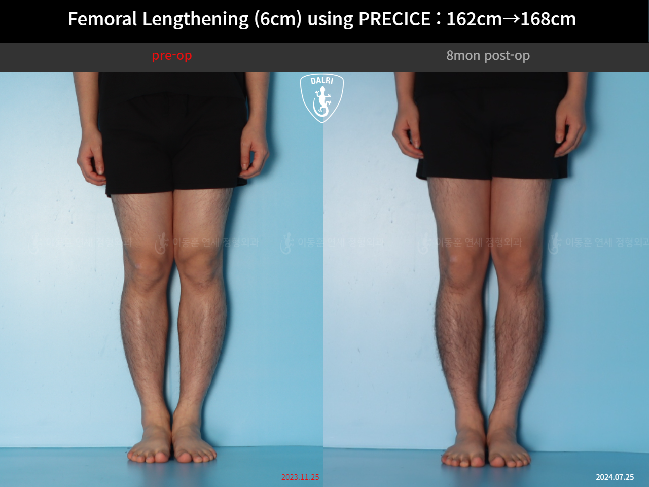 Before and after cll precice, case 52565195, image 7, Dr. Donghoon institute (DALRI)