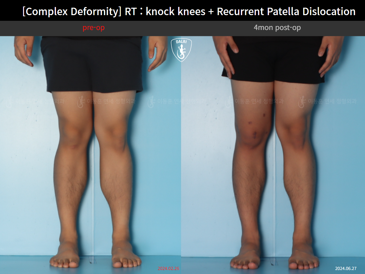 Before and after complex deformity, case 125841720, image 7, Dr. Donghoon institute (DALRI)