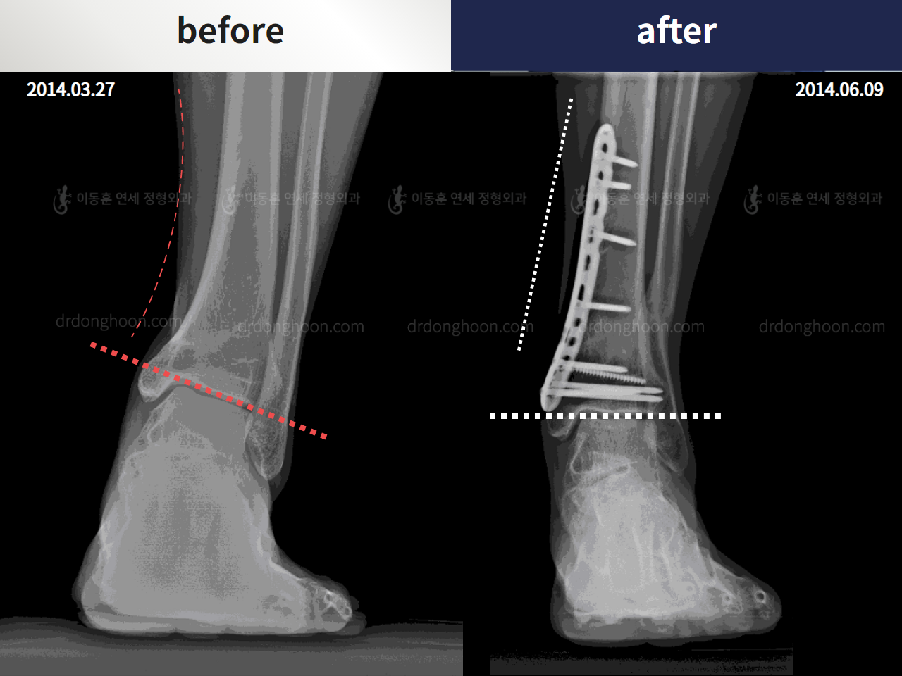 Before and after foot & ankle deformity, case 4246372, image 1, Dr. Donghoon institute (DALRI)