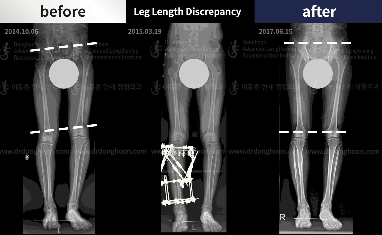 Before and after adult lld, case 4320316, image 3, Dr. Donghoon institute (DALRI)