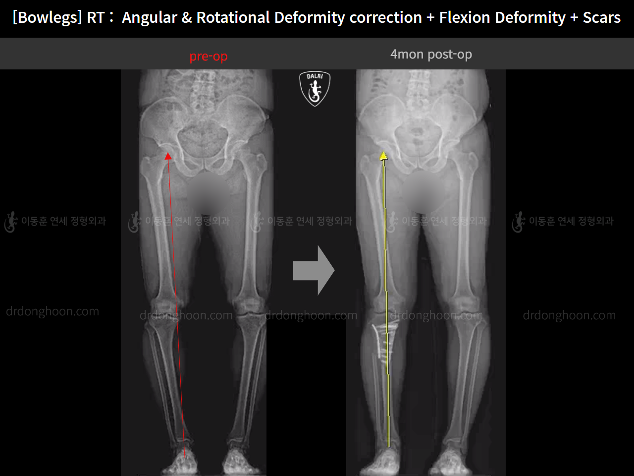 Before and after adult bowlegs, case 14701830, image 12, Dr. Donghoon institute (DALRI)