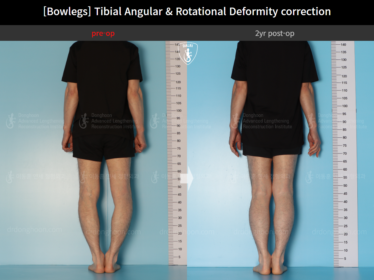 Before and after adult bowlegs, case 16933272, image 4, Dr. Donghoon institute (DALRI)