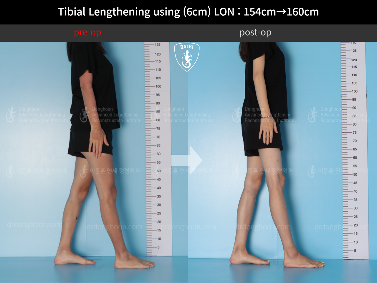Before and after cll lon, case 12786266, image 3, Dr. Donghoon institute (DALRI)
