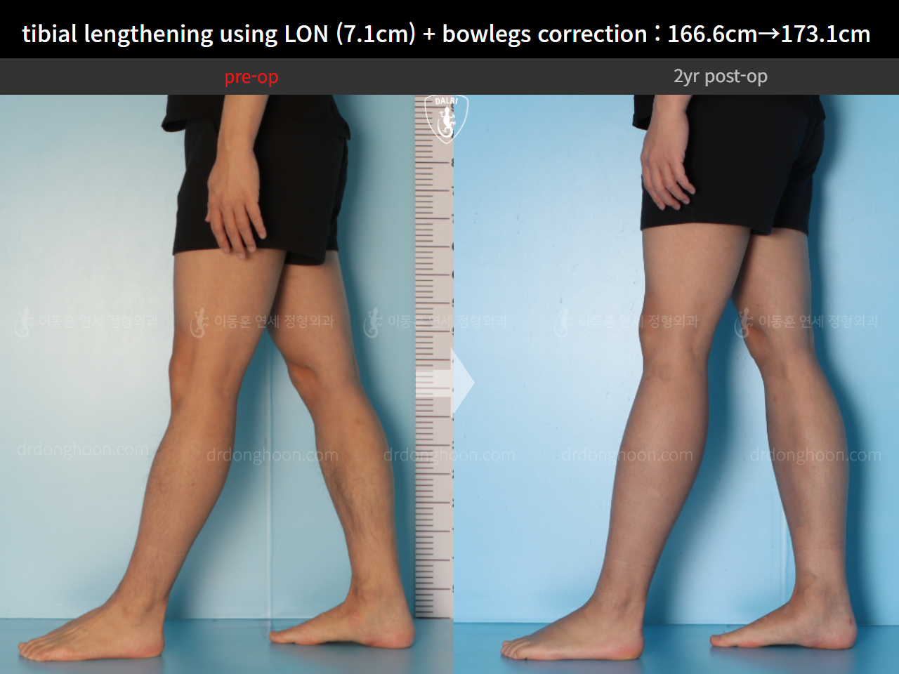 Before and after cll lon, case 14678740, image 10, Dr. Donghoon institute (DALRI)