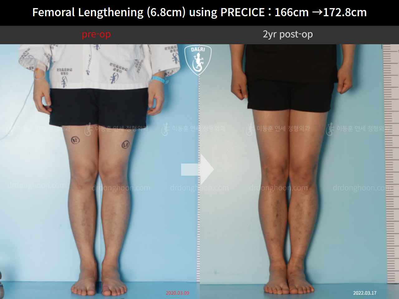 Before and after cll precice, case 10883099, image 5, Dr. Donghoon institute (DALRI)