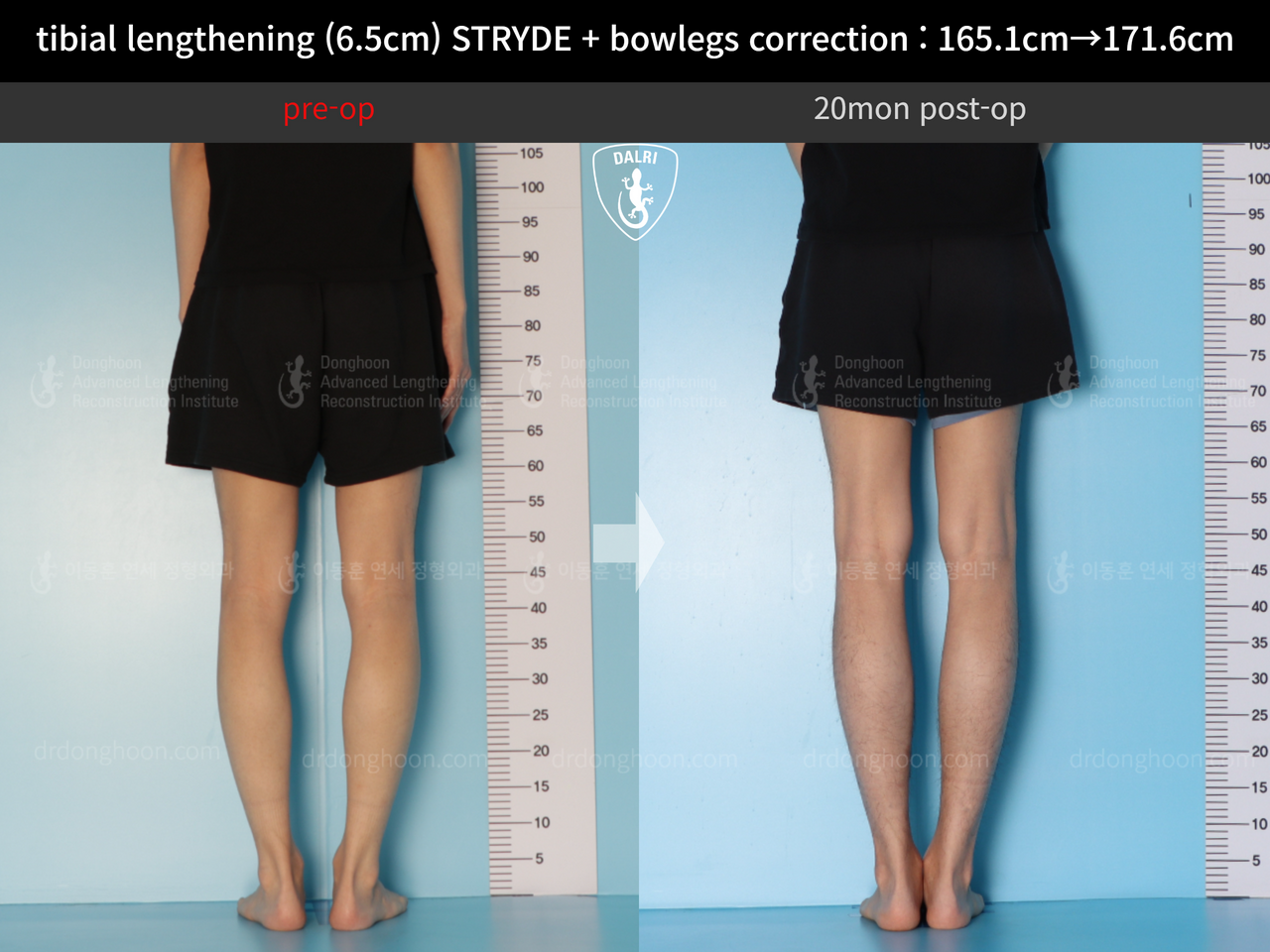 Before and after cll + deformity correction, case 13168253, image 8, Dr. Donghoon institute (DALRI)