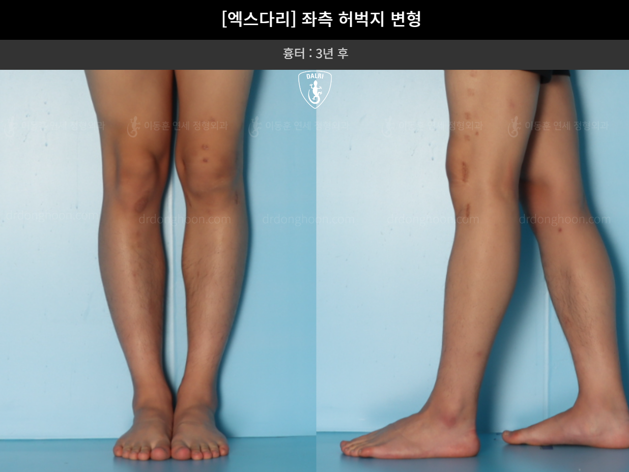Before and after adult knock knees, case 18261918, image 7, Dr. Donghoon institute (DALRI)