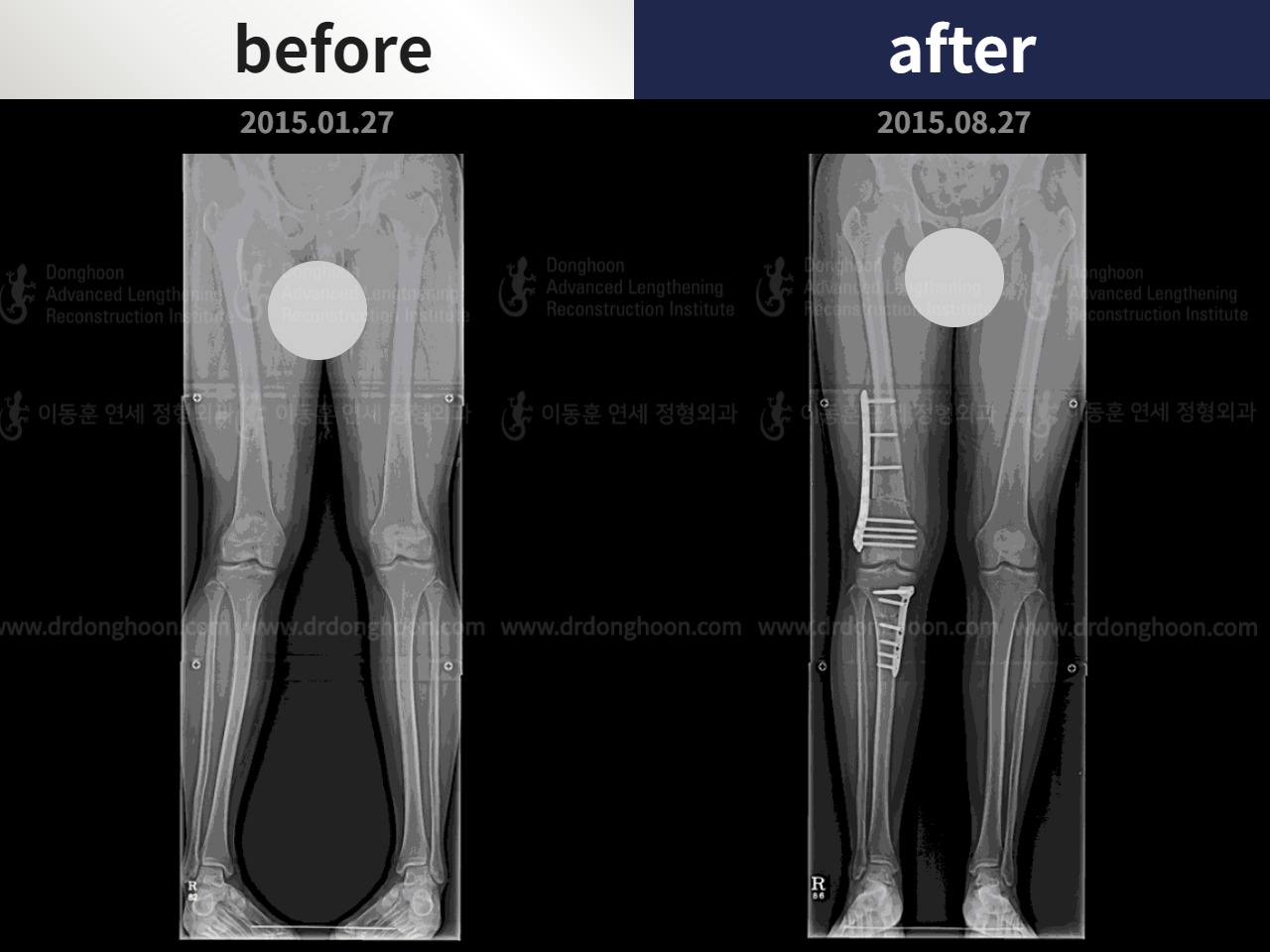 Before and after adult knock knees, case 4586307, image 3, Dr. Donghoon institute (DALRI)