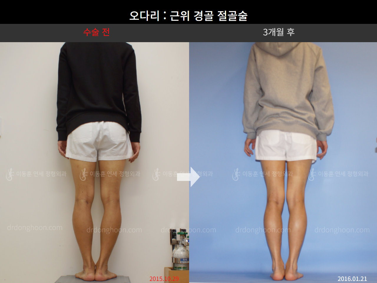 Before and after adult bowlegs, case 4311351, image 2, Dr. Donghoon institute (DALRI)