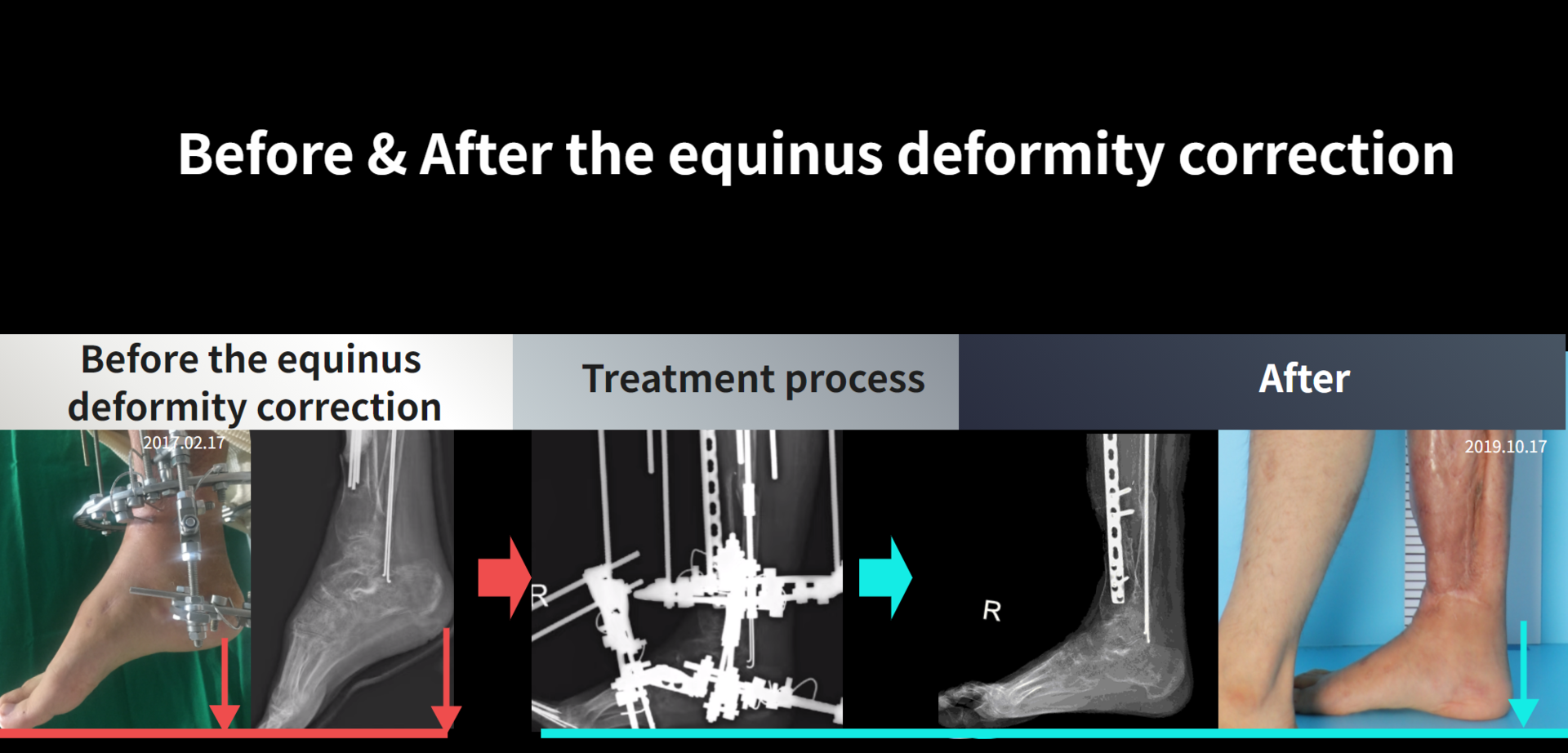 Before and after re-operation for cll, case 5200498, image 8, Dr. Donghoon institute (DALRI)