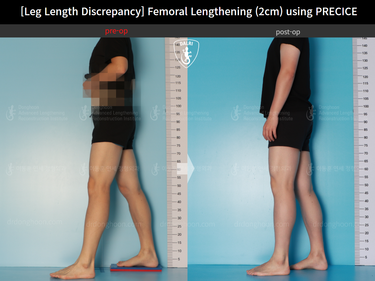 Before and after adult lld, case 16061128, image 5, Dr. Donghoon institute (DALRI)