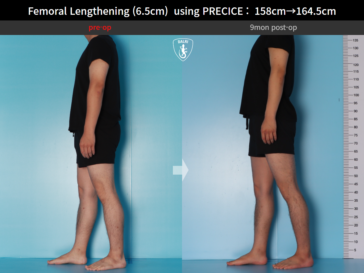 Before and after cll precice, case 28297898, image 4, Dr. Donghoon institute (DALRI)