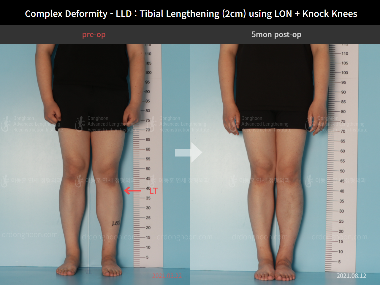Before and after complex deformity, case 8394665, image 1, Dr. Donghoon institute (DALRI)