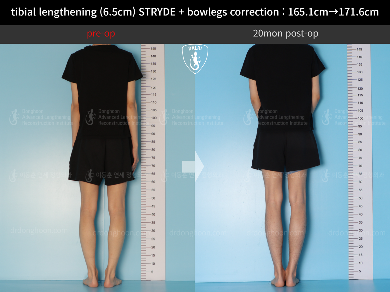 Before and after cll + deformity correction, case 13168253, image 4, Dr. Donghoon institute (DALRI)